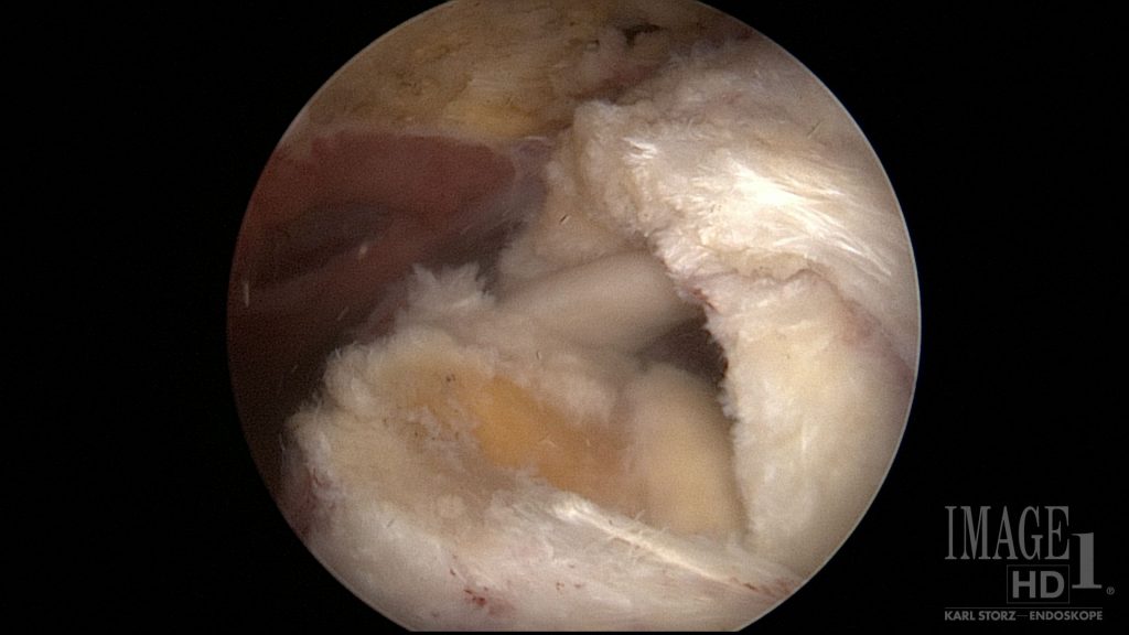 Rotator cuff tear surgery cuff repair arthroscopy shoulder