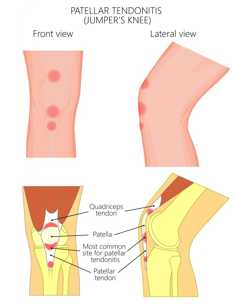 what is tendonitis, quad tendinitis, patellar tendinitis