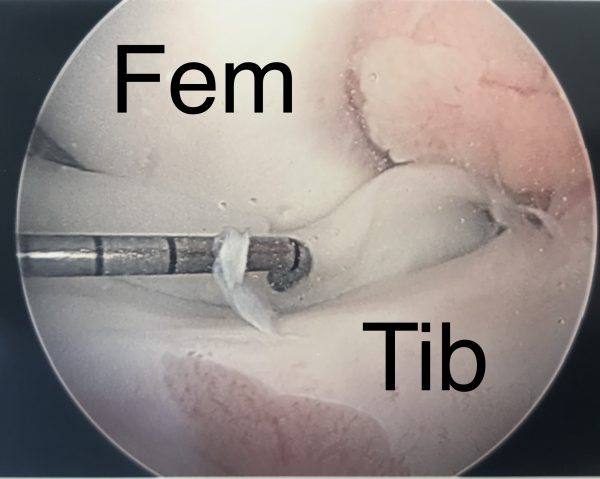 meniscus tear treatment is required for tears like this