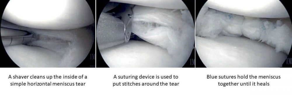 surgery for a meniscus tear. The meniscus can be repaired with surgery. This shows surgical meniscus tear treatment