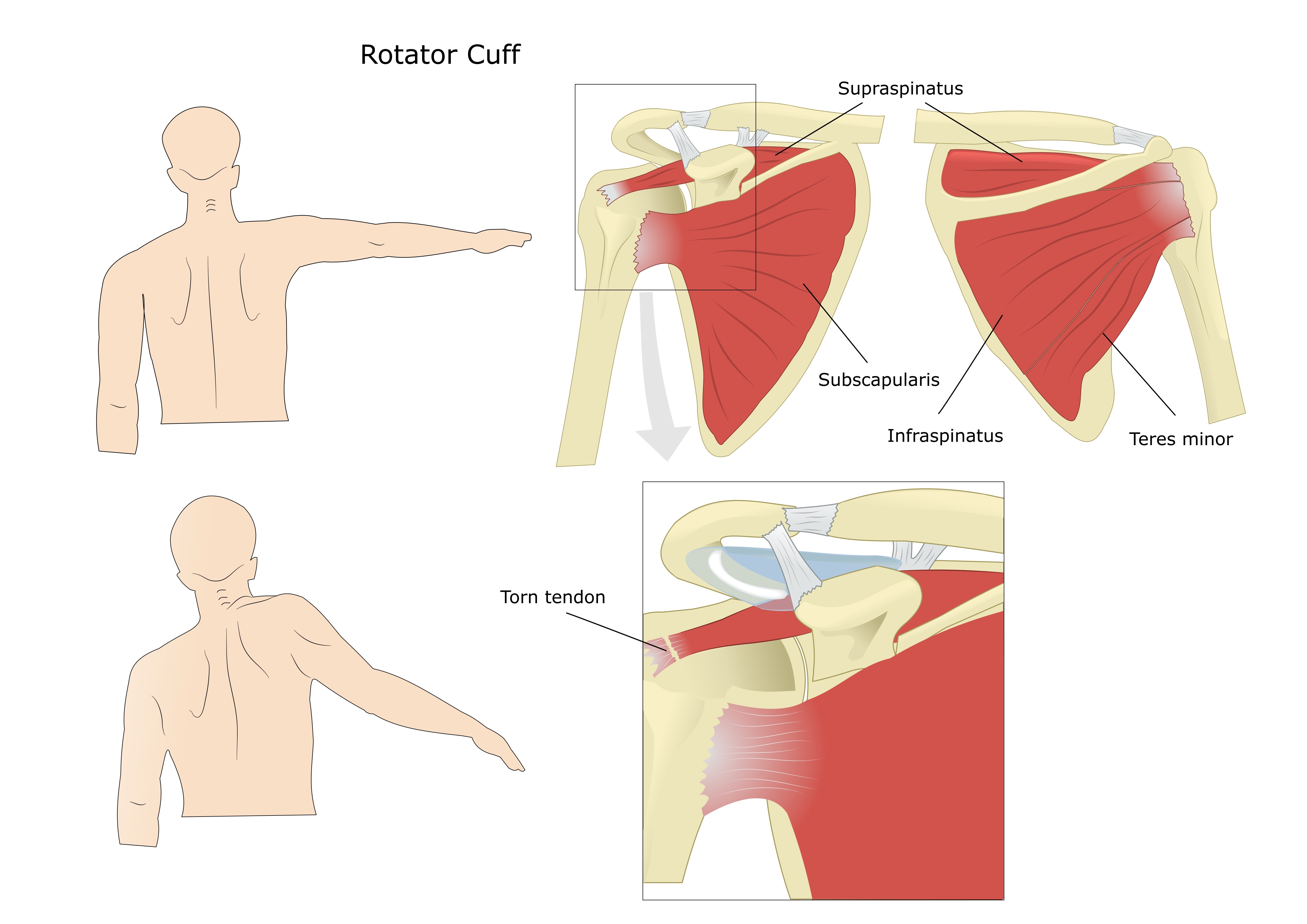 Common symptoms of a rotator cuff tear are shoulder pain and weakness.