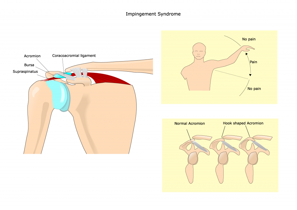 Shoulder Impingement, Impingement While Lifting, Shoulder Pain, bursitis when lifting