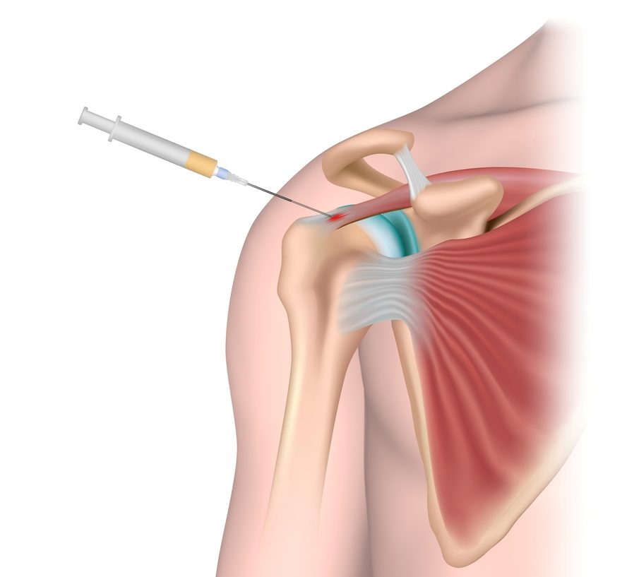 PRP, PRP injection, PRP Therapy, PRP For Cuff Tendonitis