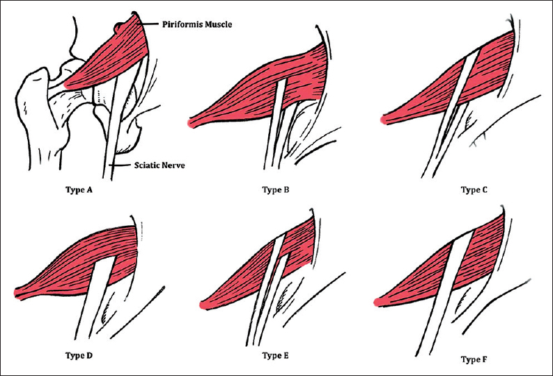 Piriformis Syndrome Larson Sports And Orthopaedics Piriformis Syndrome Larson Sports And Orthopaedics
