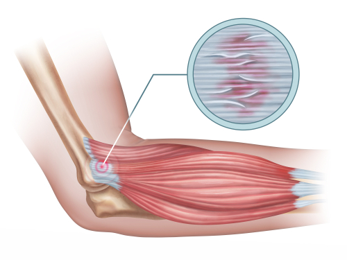 tennis elbow tendinitis