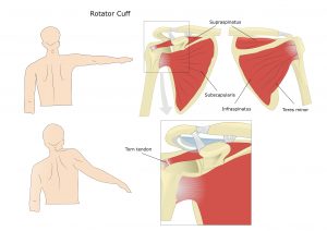 Common symptoms of a rotator cuff tear are shoulder pain and weakness.