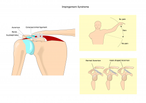 Shoulder Impingement, Impingement While Lifting, Shoulder Pain