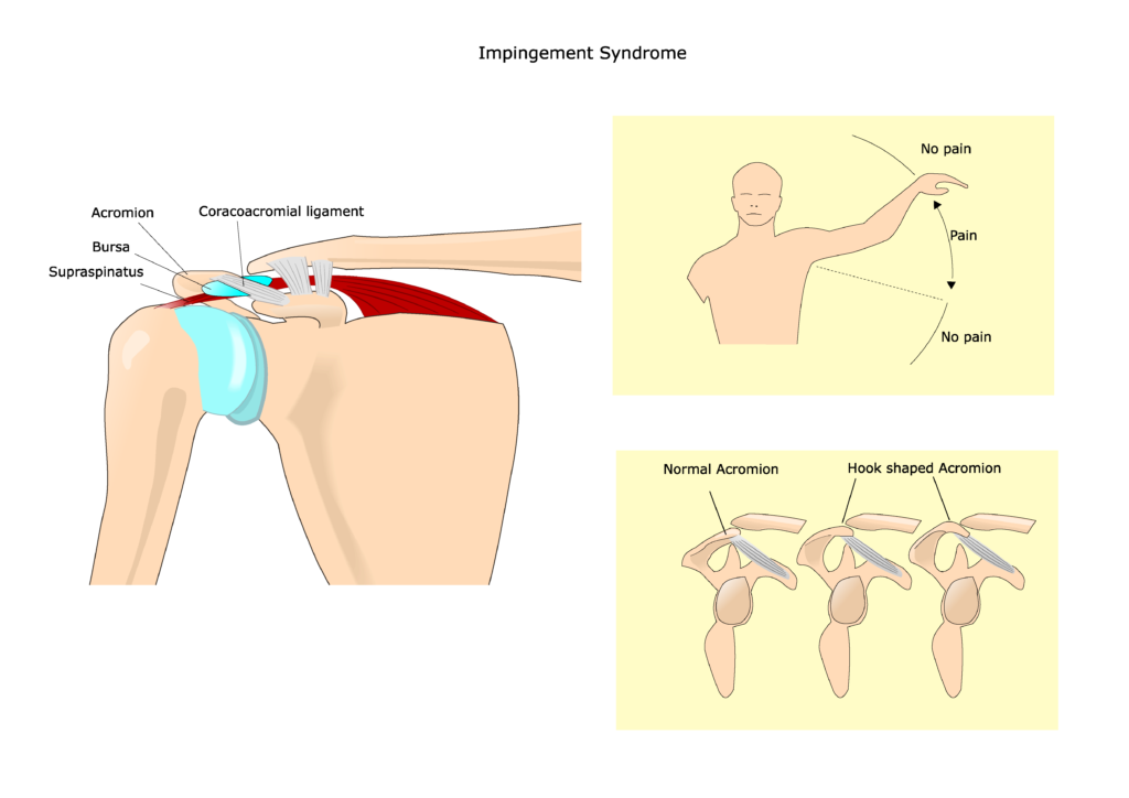 shoulder pain, shoulder impingement, bench press shoulder pain, 