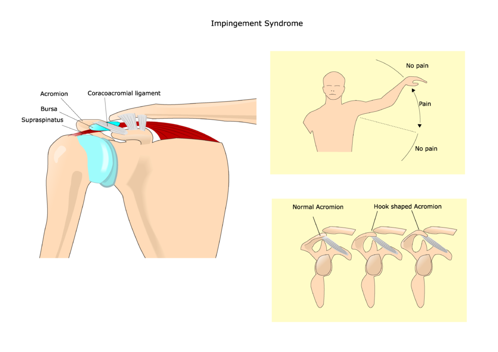 bolest ramene, rameno, impingement, bench press, ramenní bolest, 