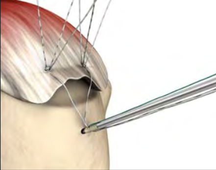 cuff rotator sling surgery after repair wear long stitches important why sutures hold together few don use if just