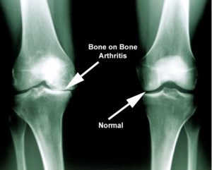 what is knee arthritis