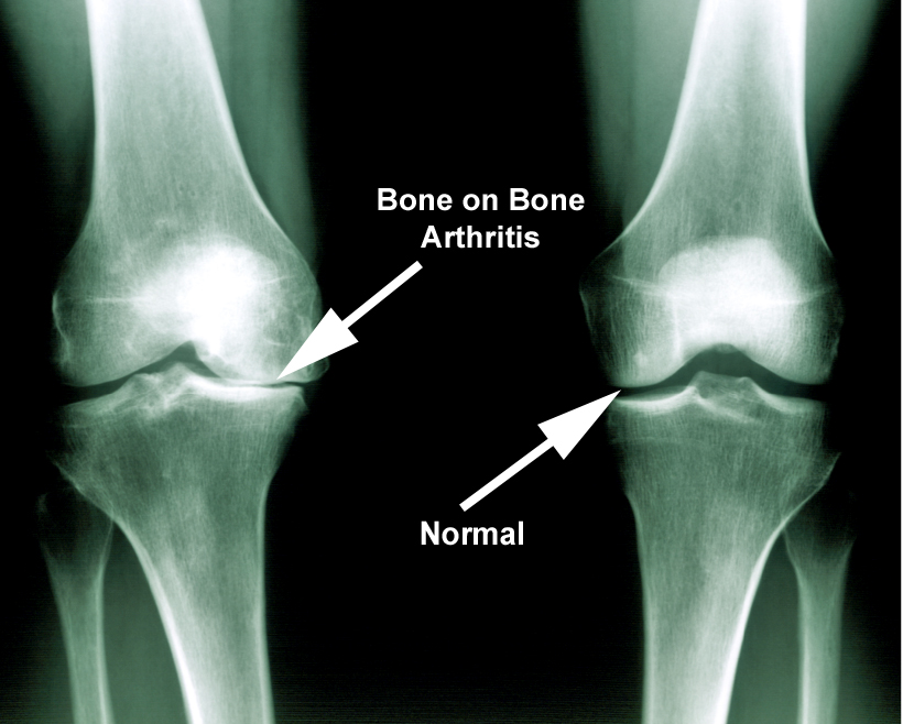 X Ray Knee Arthritis