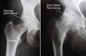 what is hip arthritis