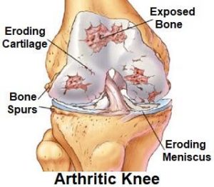 what is arthritis, knee arthritis