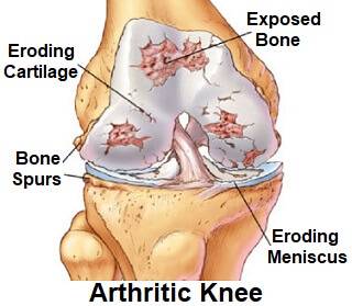 what is arthritis, knee arthritis