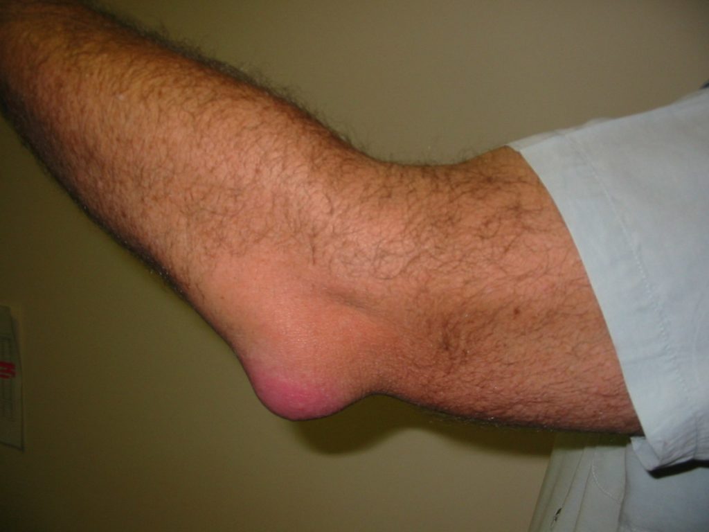 elbow pain from weight lifting, elbow pain while lifting, olecranon bursitis, elbow swelling