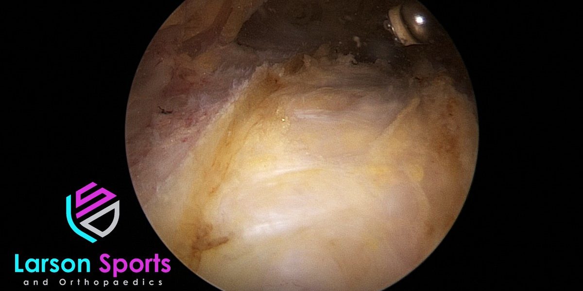 trochanteric bursitis surgery, arthroscopic trochanteric bursectomy