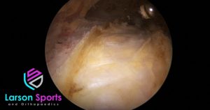 trochanteric bursitis surgery, arthroscopic trochanteric bursectomy