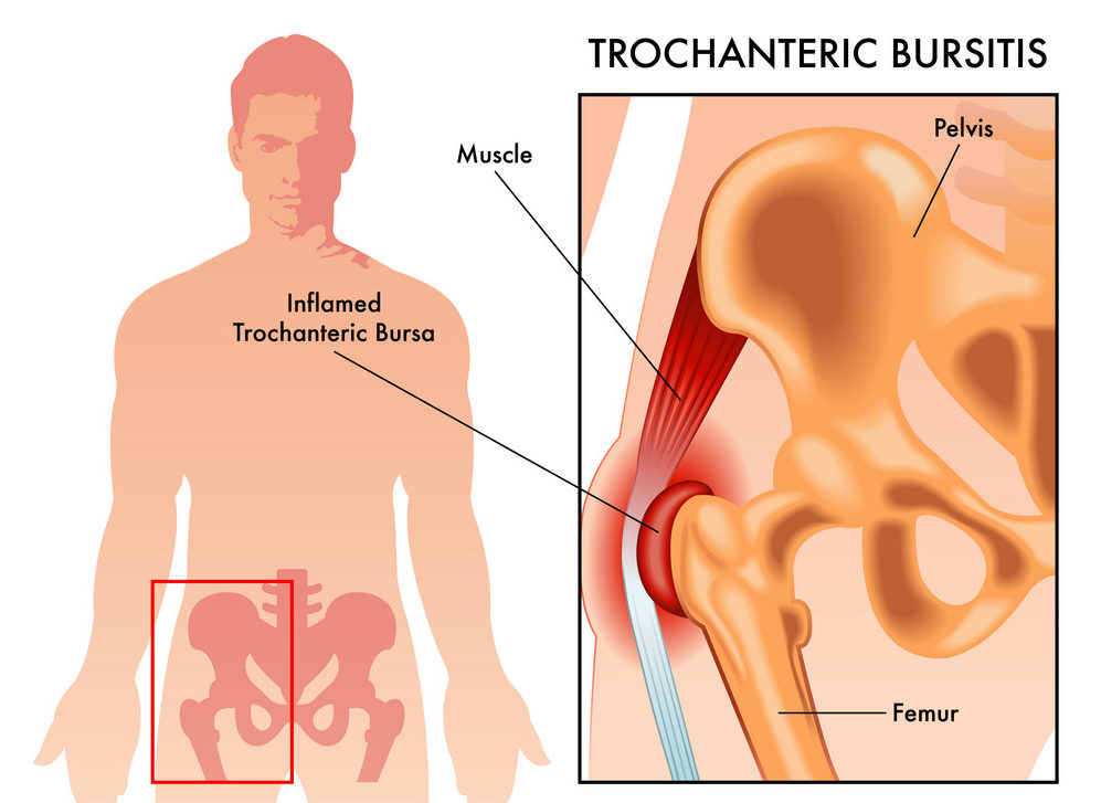 trochanteric bursitis